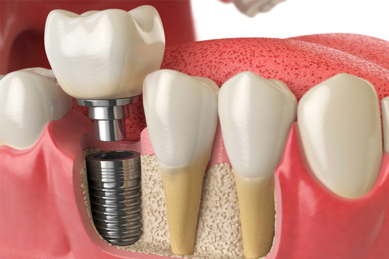 implantacia